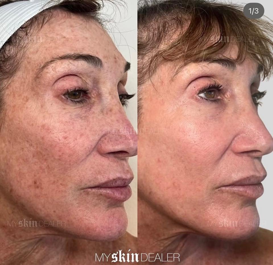 Local Guide to Best Estheticians in Boca & Delray